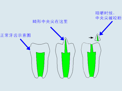 <b>畸形中央尖的治疗方法</b>