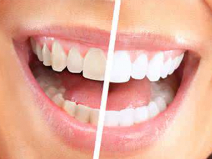 牙齿黑黄刷牙可以变白吗?？