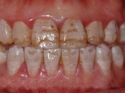 <b>氟斑牙是怎么形成的</b>