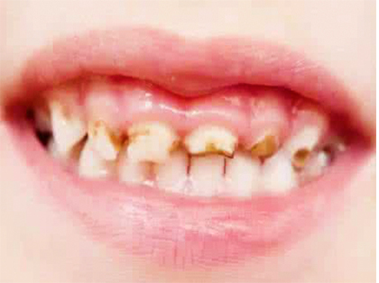 <b>什么是牙釉质发育不全？</b>