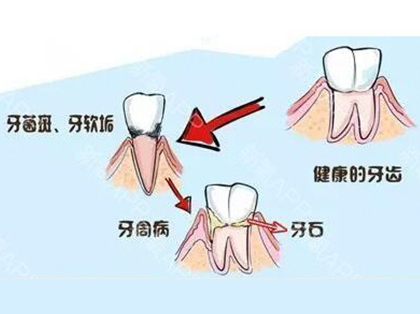 <b>牙结石的危害是什么？</b>