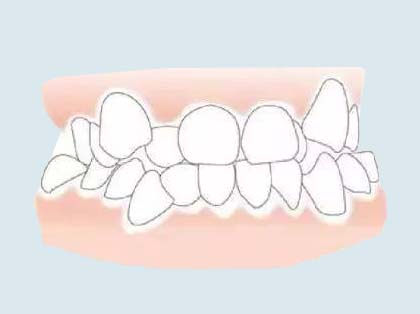 <b>常见的牙齿不齐有哪几种？</b>