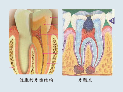 <b>急性牙髓炎是如何引起的</b>