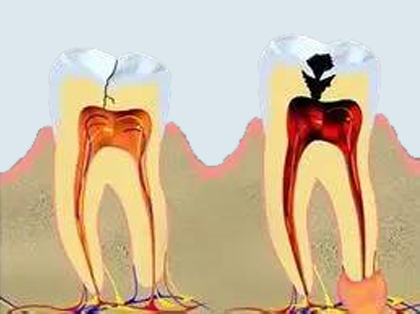 <b>什么是牙髓炎？</b>