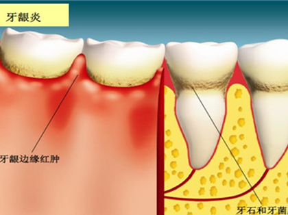 <b>牙龈炎会导致牙齿松动吗？</b>