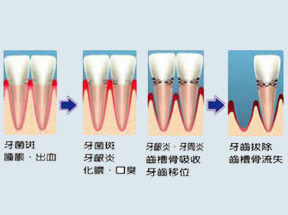 <b>牙龈炎和牙周炎的区别</b>