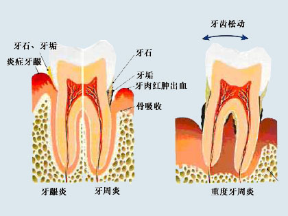 <b>牙周炎的主要症状是什么</b>