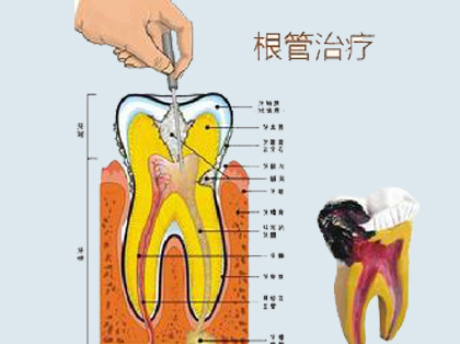 <b>根管治疗后牙齿的寿命有多久</b>