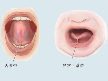 <b>舌系带矫正疼不疼</b>